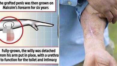 英男子會陰嚴重感染，醫生在其手臂重建功能，6年后移植回襠部